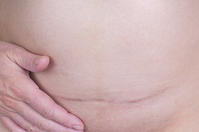 This scar is not just on the surface, remember, it’s many layers deep into the belly.